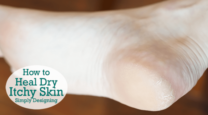 Dry Skin (Xerosis) in Adults: Condition, Treatments, and ...