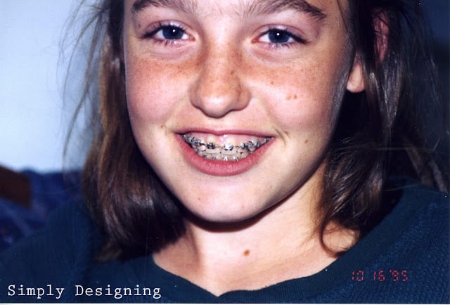 braces1 | No more Brace-Face with Invisalign {warning embarrassing photos of me ahead} #ad #INVStraightTalk | 12 |
