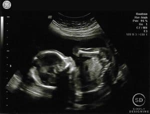 20 week ultrasound